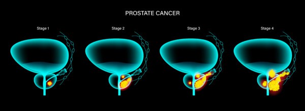 Illustration of prostate cancer stages.
