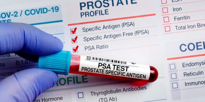 Image of gloved hand holding vial of blood labeled PSA test.